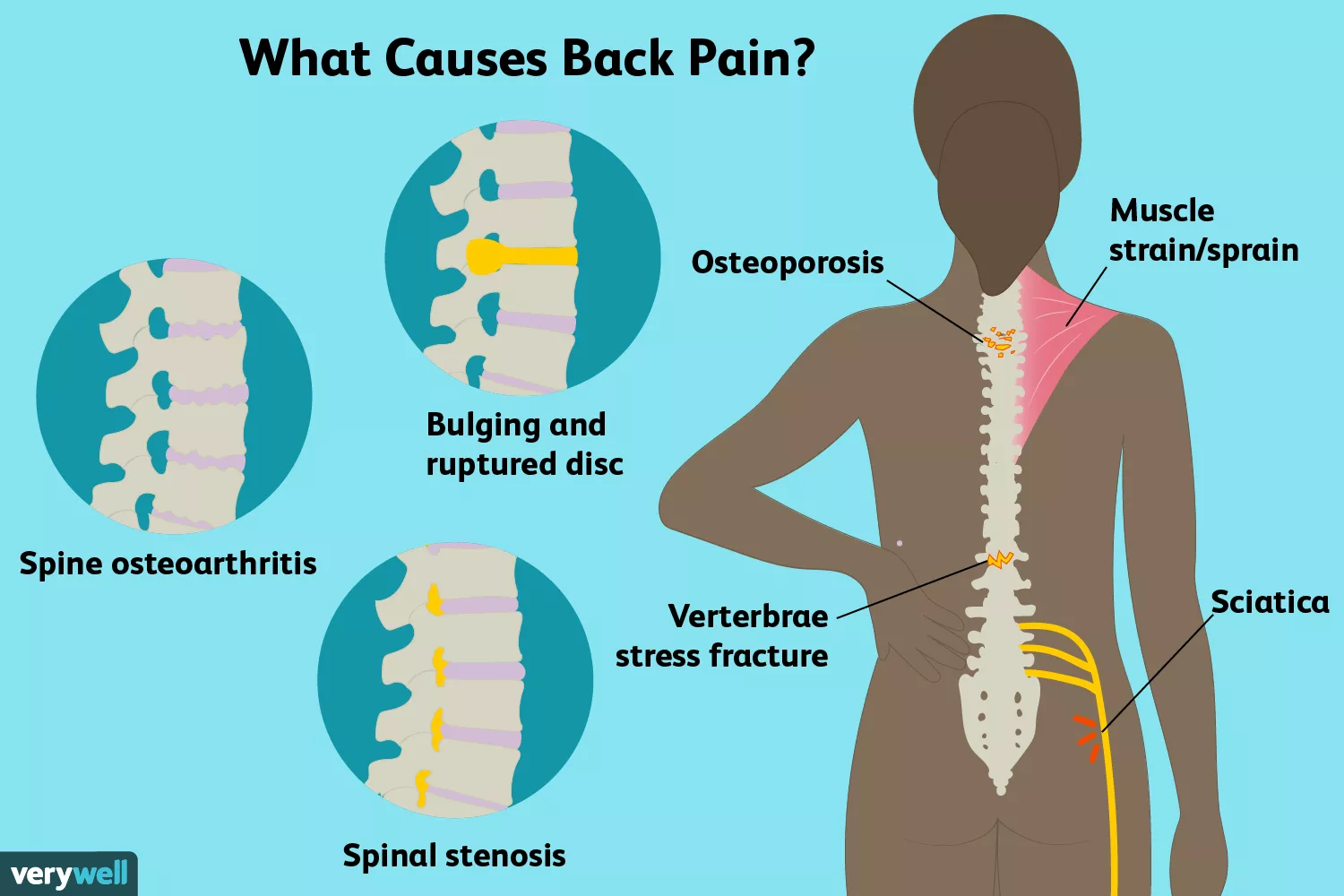 What Causes Back Pain infographic